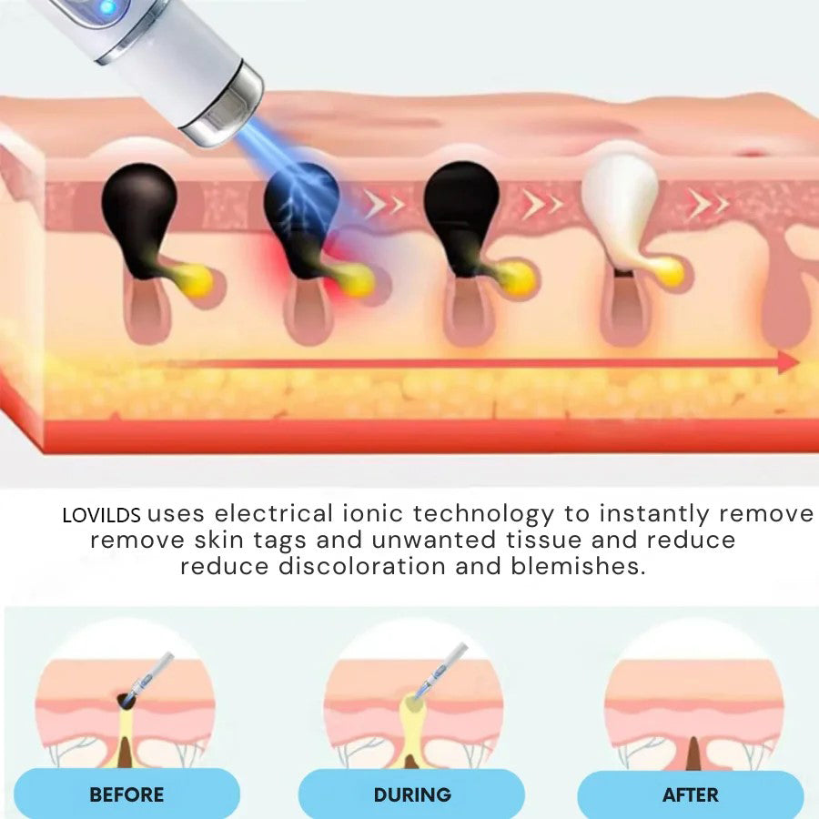 🔥【OFFICIAL STORE】LOVILDS®  Non-Invasive Mole and Wart Removal Laser Pen