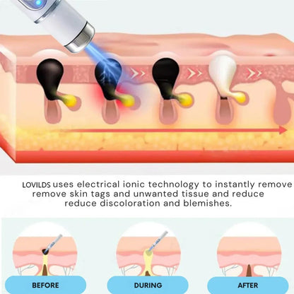🔥【OFFICIAL STORE】LOVILDS®  Non-Invasive Mole and Wart Removal Laser Pen