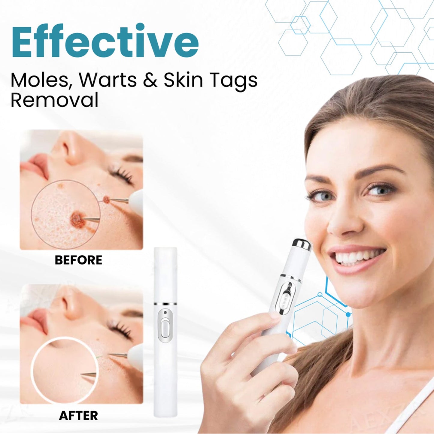 🔥【OFFICIAL STORE】LOVILDS®  Non-Invasive Mole and Wart Removal Laser Pen