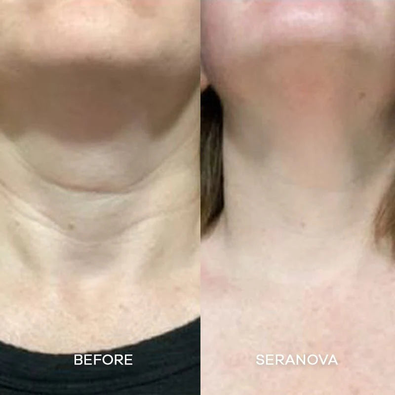 Cougex™ The Micro needling Infusion System