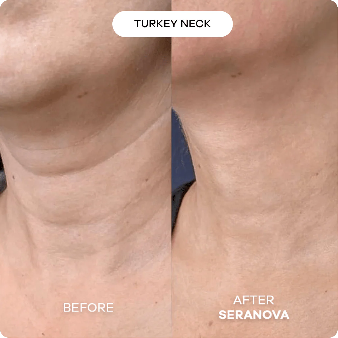 Cougex™ The Micro needling Infusion System