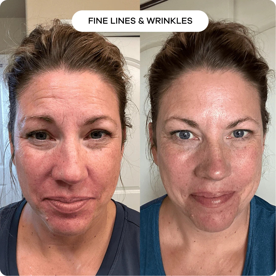 Cougex™ The Micro needling Infusion System