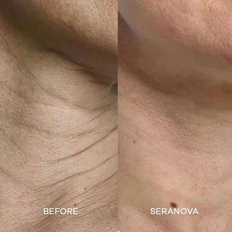 Cougex™ The Micro needling Infusion System